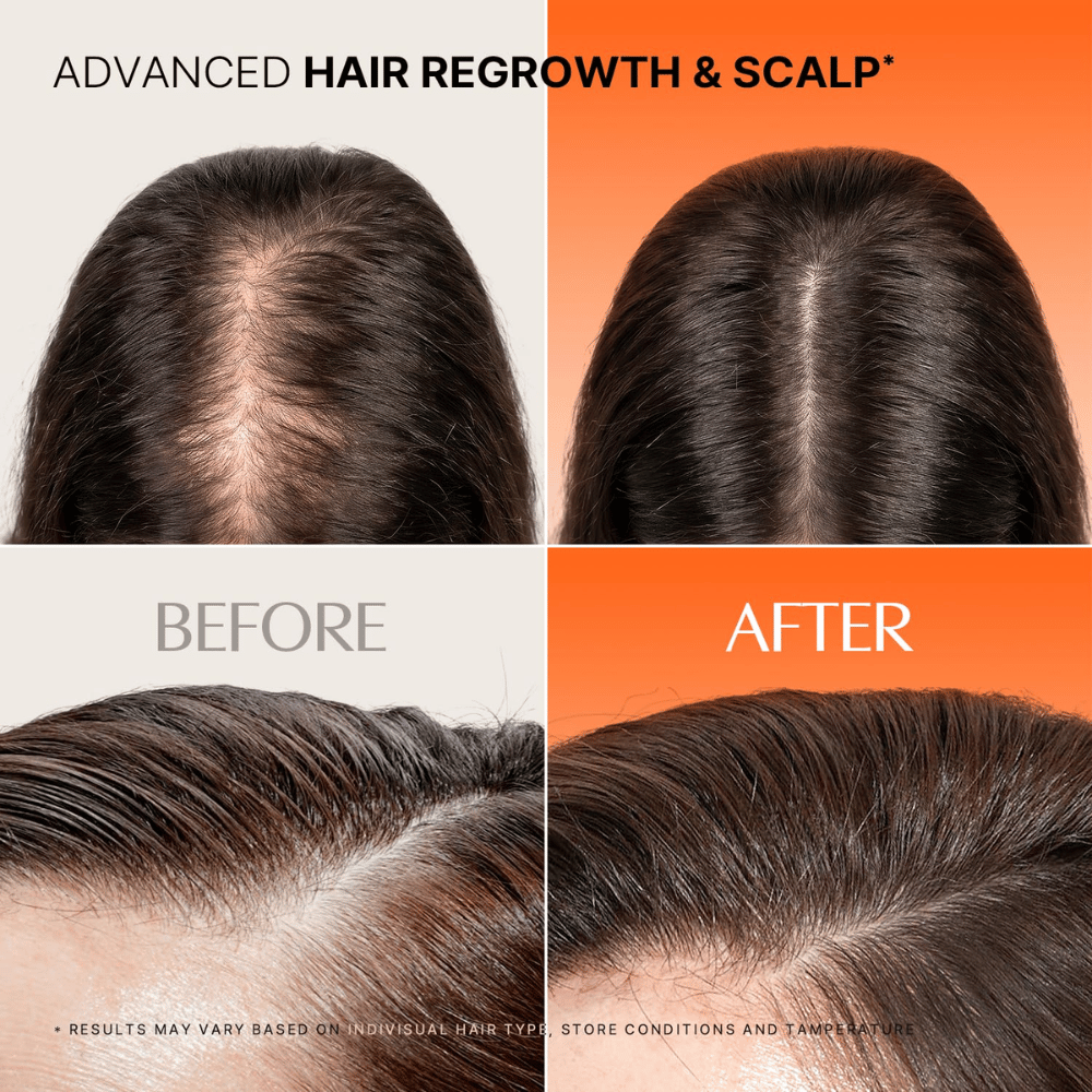 Before-and-after image of hair and scalp when using LILYEVE Grow Turn Exosome Spicule Ampoule 3000.
