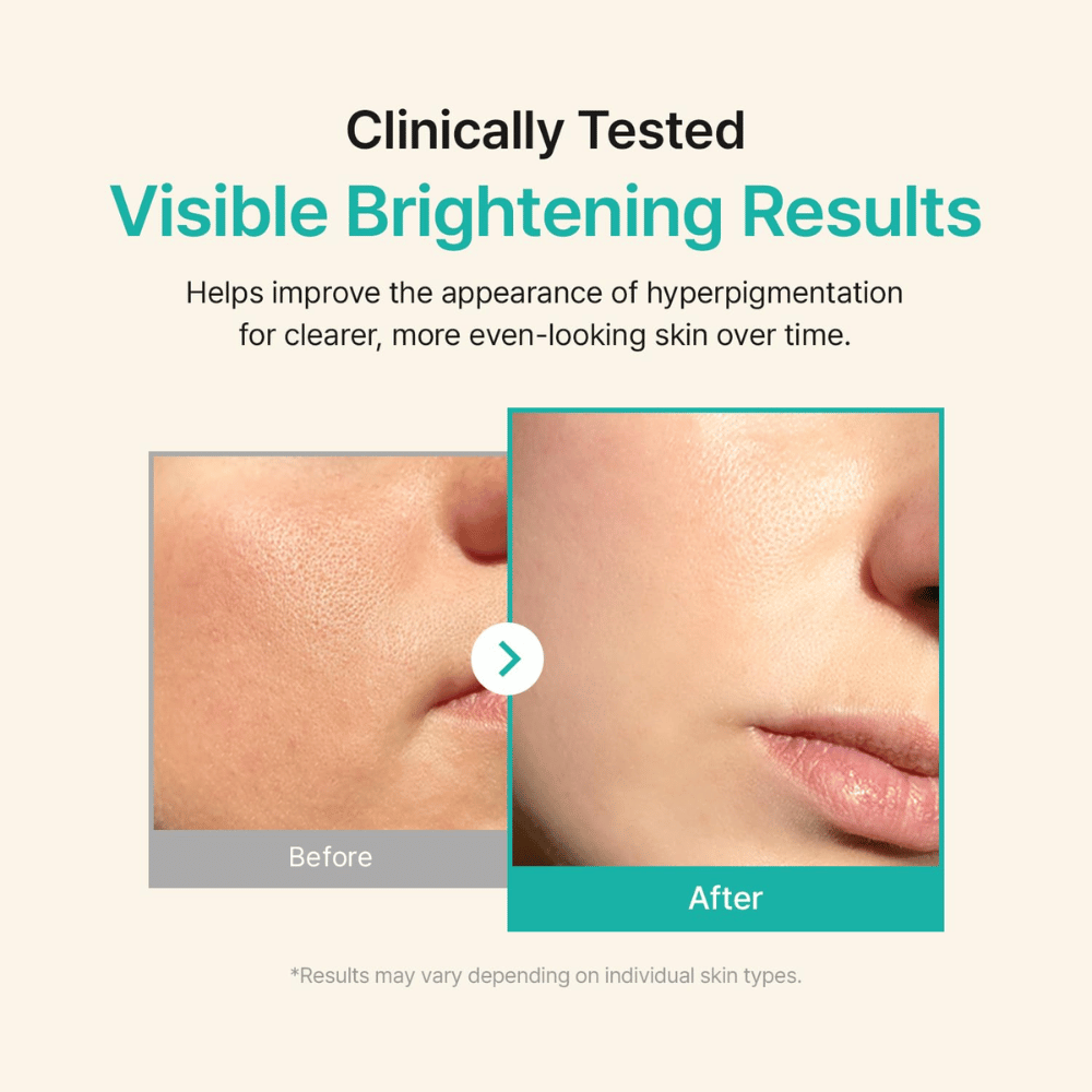Before-and-after image showing a clearer skin tone and reduced visibility of pigmentation and unevenness.